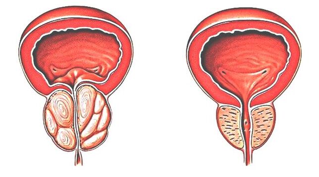 Prostatitis en normale prostaat