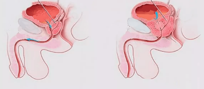Tekenen van prostatitis bij mannen