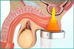 Behandeling van prostatitis