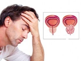 Prostatitis bij een man