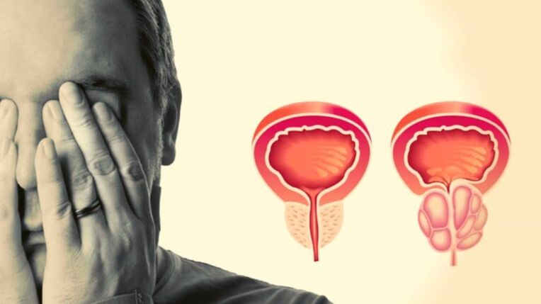 Een man heeft prostatitis