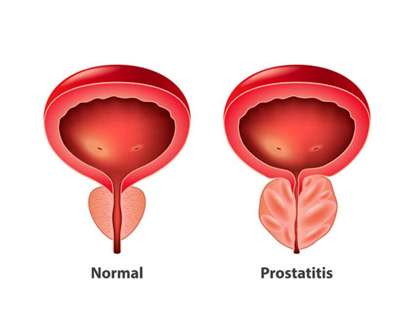 normale en inflammatoire prostaat