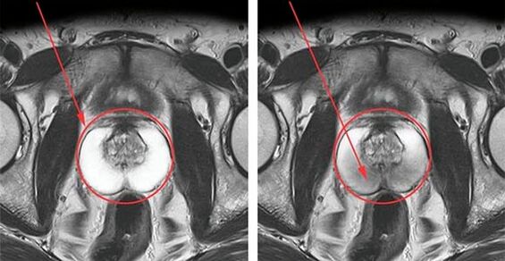 Normale prostaat (links) en ontsteking van de prostaat met prostatitis (rechts)